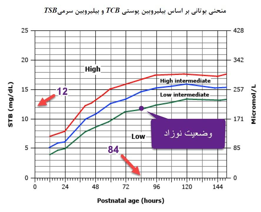 نمونه ای از جاگذاری عدد بیلی روبین در نمودار زردی نوزاد