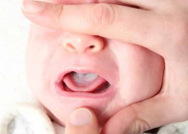 برفک دهان به وجود ضایعات سفید روی زبان یا مخاط دهان نوزاد می گویند
