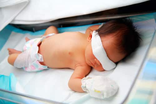 در هنگام استفاده از دستگاه فتوتراپی نوزاد باید چشم بند داشته باشد و طاق باز خوابیده باشد.