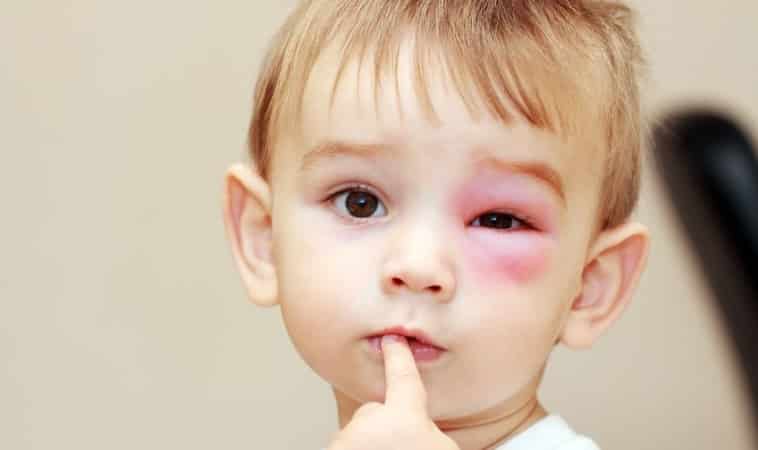 علائم آلرژی به آجیل در کودکان متفاوت است
